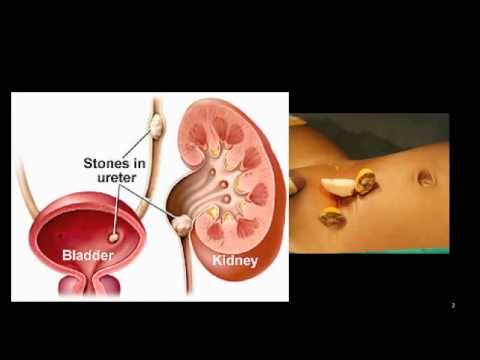 Bladder Stones