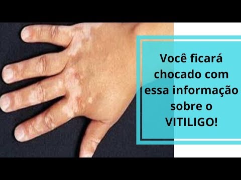 Você ficará chocado com essa informação sobre o VITILIGO!