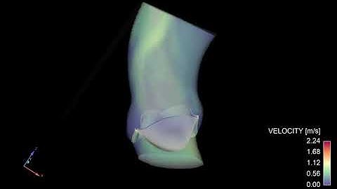 Fluid Structure interaction of  aortic valve ,  Ansys Fluent / mechanical