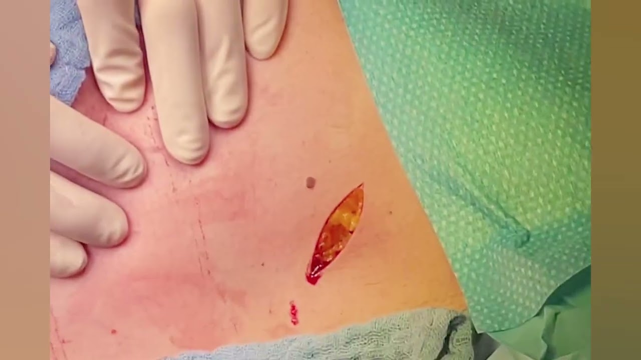 Segmentresection (Breast conservation) for invasive breast cancer and Sentinel node biopsy