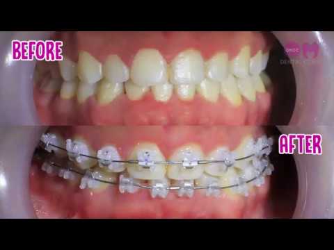 Signature Sapphire Braces by OMDC Dental Clinic YouTube