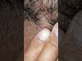 ASMR Relaxing beard hiar satisfying #satisfying #beard #ingrown #shortvideos #asmr #scratch