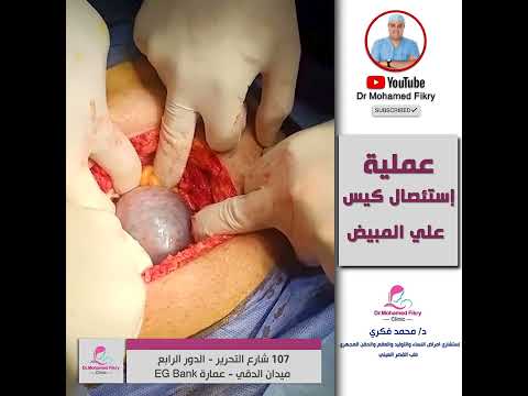 شاهد عملية استئصال كيس علي المبيض 