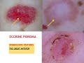 Benign and malignant pink lesions  dr teresa russo