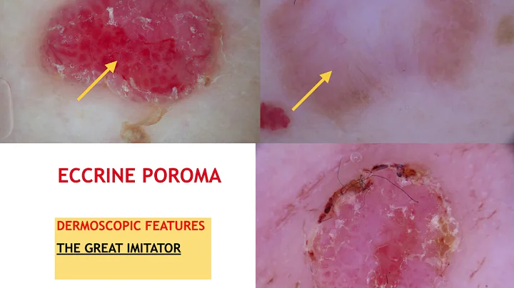 Benign and Malignant Pink Lesions - Dr. Teresa Russo