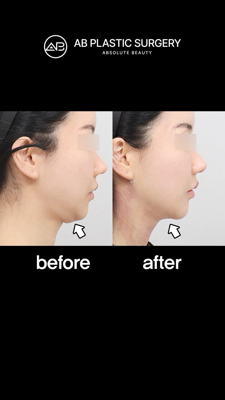 Double Chin GONE! ✨ The Magic of a Feminine Jawline. #shorts