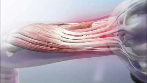 Lateral Epicondylitis: Learn@Visible Body