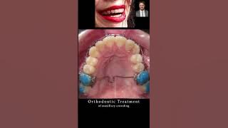 🤔 Maxillary expansion❓ Crowding in Orthodontics