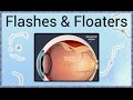 Flashes & Floaters - A Sign of Retinal Detachment