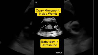 Baby Boy in Ultrasound #medical #ultrasound #pregnant