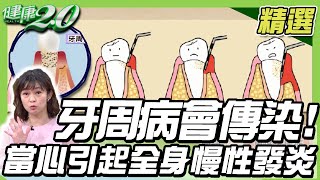 牙周病會傳染！當心會引起全身慢性發炎？牽一齒動全身 傷身又傷財【健康2.0精選】