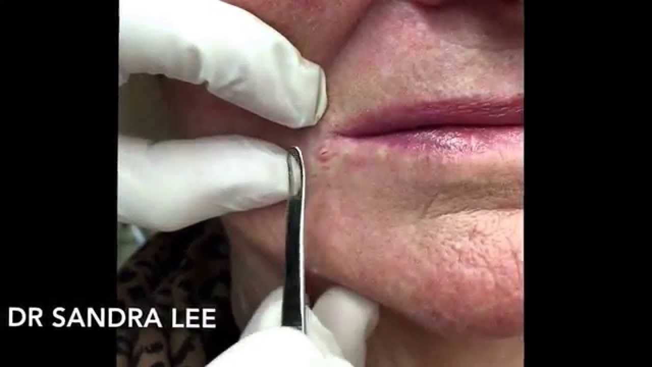 Just Popping Milia For Medical Education Nsfe Youtube