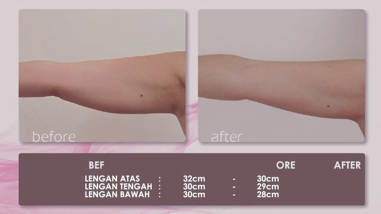 rf slimming adalah