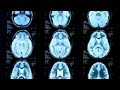 Seizures vs. Epilepsy | Epilepsy