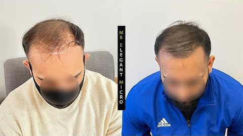 Close-up view-Scalp micropigmentation