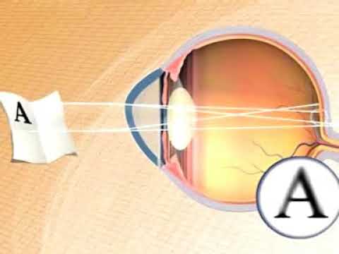 Como se puede corregir el astigmatismo