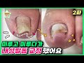 (eng sub)[2편]항상 건들 때마다 아팠는데 안 아픈 건 처음이네요ㅎㅎ｜레푸스 서면점/사상점｜ingrown toenail｜Athlete&#39;s foot-Fresh Foot