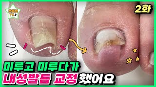 (eng sub)[2편]항상 건들 때마다 아팠는데 안 아픈 건 처음이네요ㅎㅎ｜레푸스 서면점/사상점｜ingrown toenail｜Athlete&#39;s foot-Fresh Foot