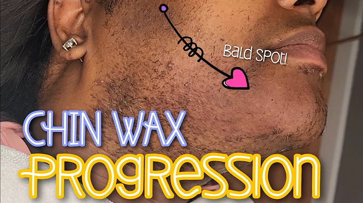 Chin/Beard Wax Progress!! 3rd Wax Session! #hirsut...