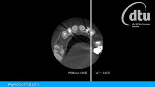 #Carestream CS 9600  #CSMAR   Unique Metal Artifact Reduction Technology
