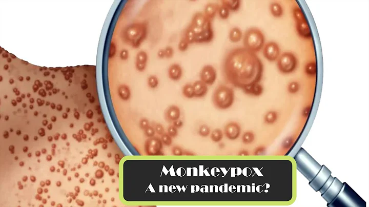 MONKEYPOX OUTBREAK | Mpox Symptoms, Transmission, Treatment.