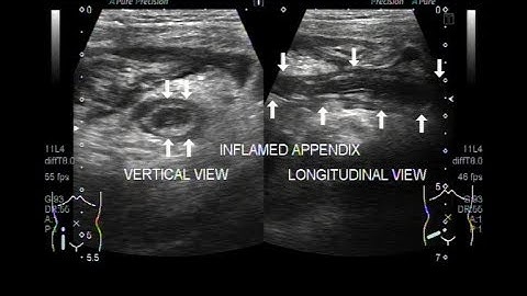 Ultrasound Video showing Inflamed Appendix with fecolith seen in its interior.