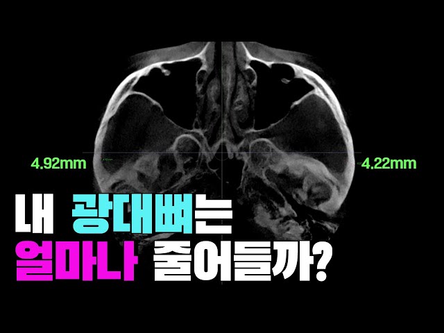 내 광대뼈 축소 몇mm 넣을 수 있을까? 불유합, 볼처짐, 과교정 예방법