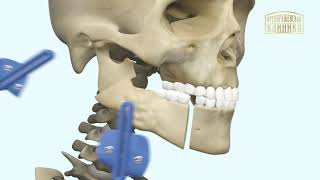 Реконструкция челюсти. Микрохирургия челюсти. 3D-анимация хода операции.