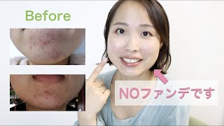 私のニキビ肌が改善した理由 Youtube 私のニキビ肌が改善した理由 Youtube