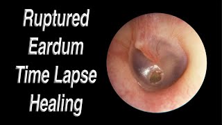 Ruptured Eardrum Healing Closed Time Lapse - A Hole in Eardrum Usually Heals Closed on Its Own! by Fauquier ENT 39,878 views 5 months ago 48 seconds