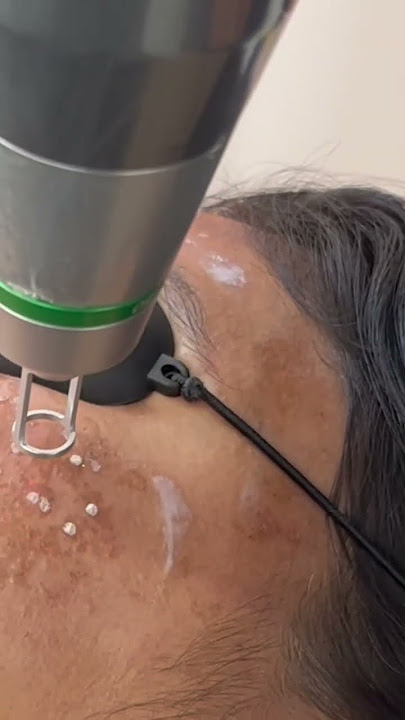 ND Yag Q switch laser for Melasma