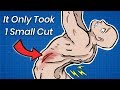 How 1 Small Cut Can Break Your Spine