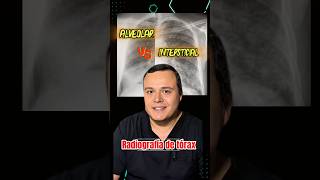 Patrón Alveolar Vs Intersticial , En Rx De Tórax. Ya Sabes Diferenciarlo?