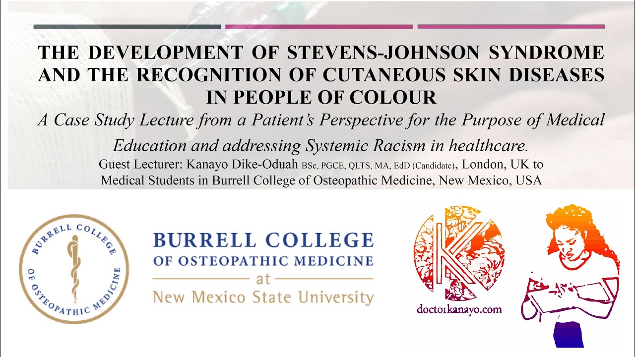 Development of Stevens-Johnson Syndrome in People of Colour: A Case Study Lecture for SNMA, BCOM