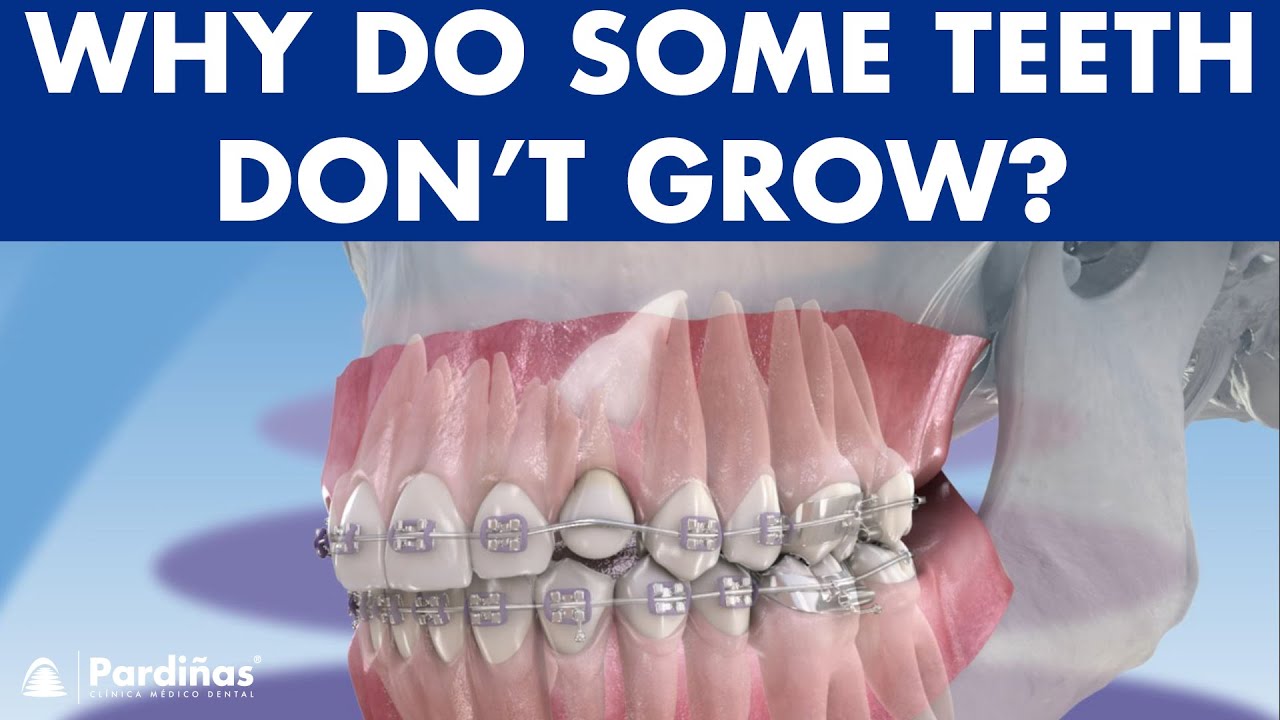 IMPACTED TOOTH What To Do When Permanent Teeth Don t Grow YouTube IMPACTED TOOTH What To Do When Permanent Teeth Don t Grow YouTube