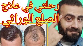 تجربتي الخاصة من المينوكسيديل الي زيت الروزماري لعلاج الصلع الوراثي و انبات الشعر في مقدمة الراس