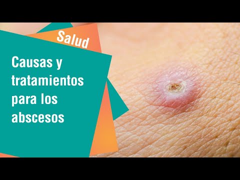 Conozca las causas y tratamientos para los abscesos | Salud