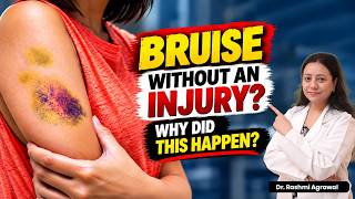 Random Bruises on Your Body? Here’s What They Could Mean