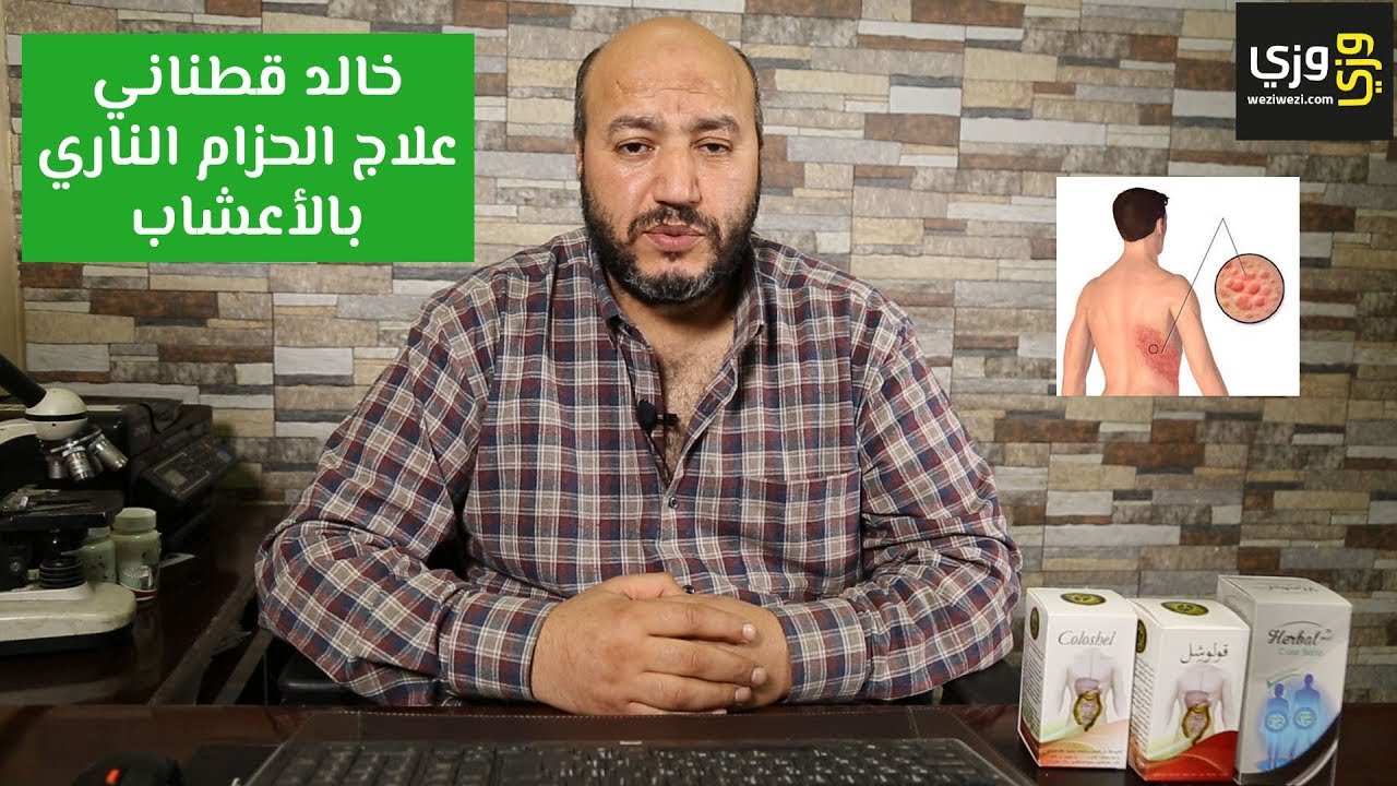 علاج الحزام الناري بالأعشاب