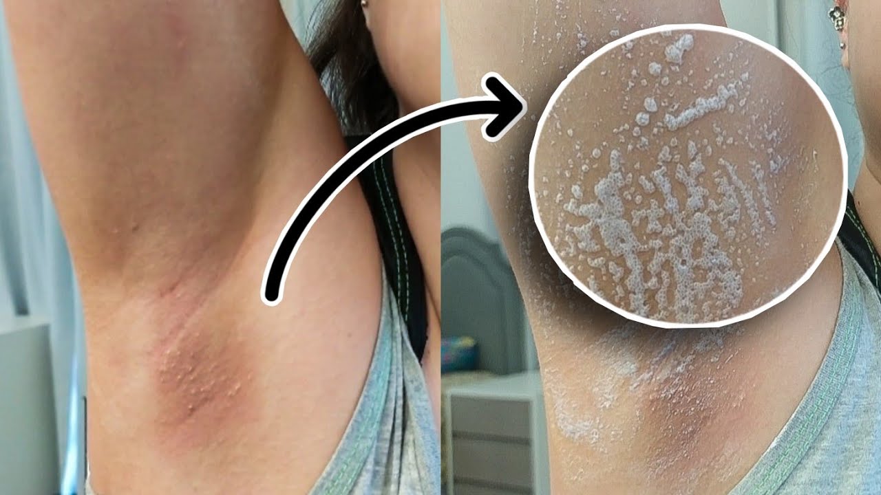 TESTEI UMA RECEITA CASEIRA PARA CLAREAR AS AXILAS E O RESULTADO NÃO FOI ...