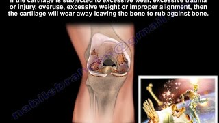 Knee Pain , Knee arthritis treatment  - Everything You Need To Know - Dr. Nabil Ebraheim, M.D.