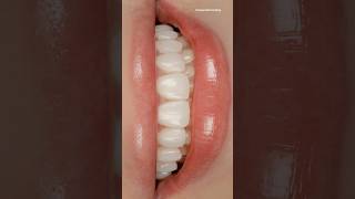 As easy as that 😉 Composite bonding by Dr. Sonnie! #naturalsmile