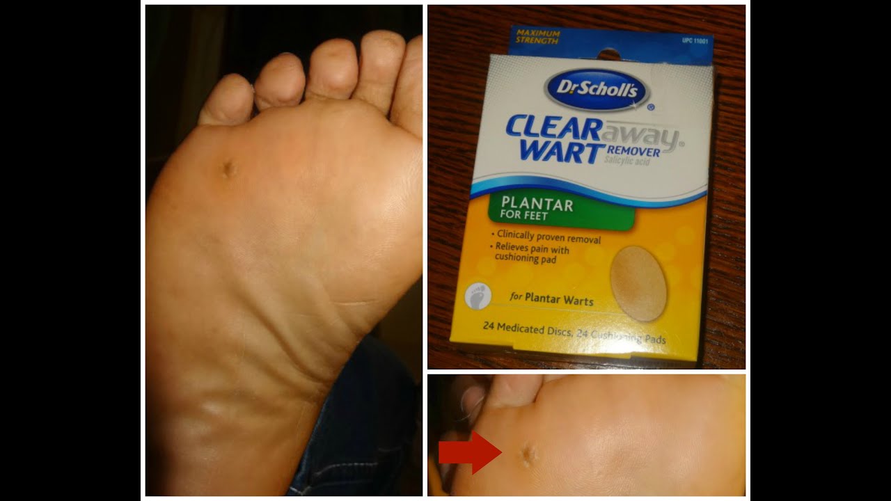 dr scholl's wart remover pads