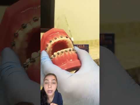 نحوه مسواک زدن در زمان ارتودنسی