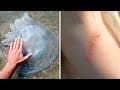 How To Treat Jellyfish Stings Naturally