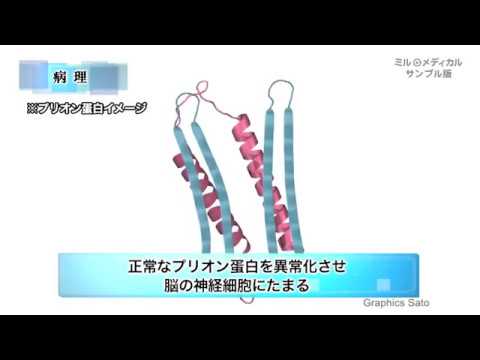 クロイツフェルト・ヤコブ病／ミルメディカル　家庭の医学動画版