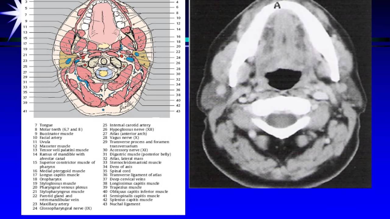 CT MRI LARYNX PHARYNX ANATOMY - YouTube