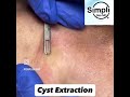 Cyst Extraction