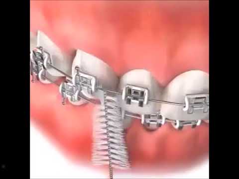 كيفية تنظيف الأسنان بعد تركيب التقويم    