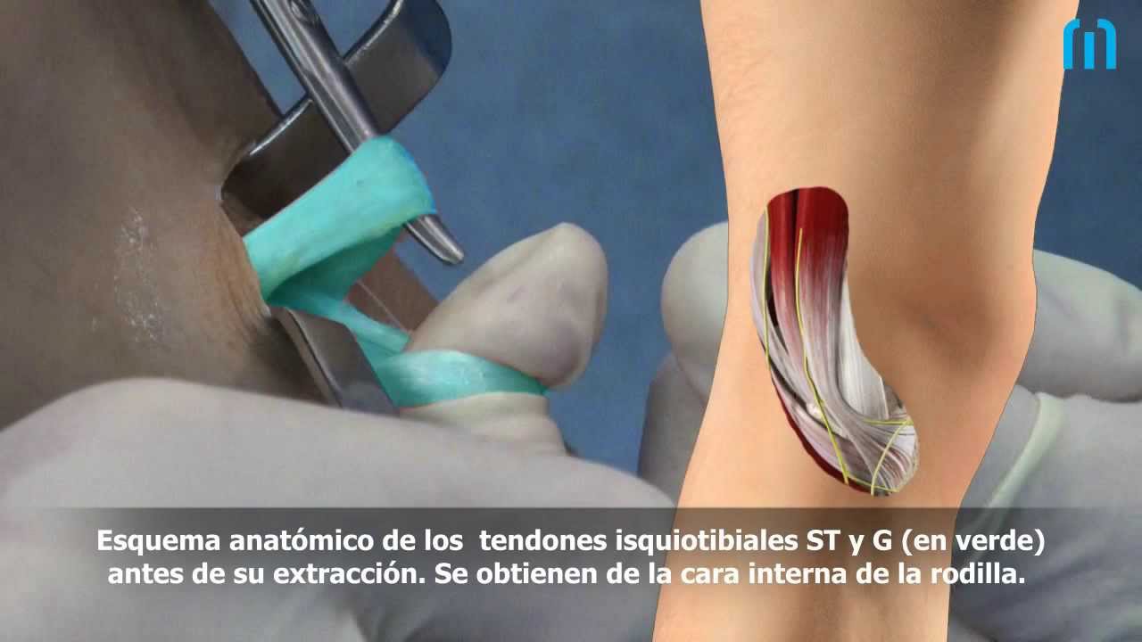 Recuperación del ligamento cruzado anterior - DR BALLESTER- TRAUMATOLOGIA  CIRUGIA ORTOPEDICA